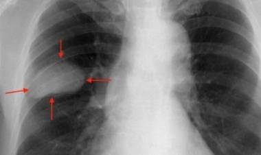 Cáncer de pulmón: llegó al país un tratamiento que logra una sobrevida inédita