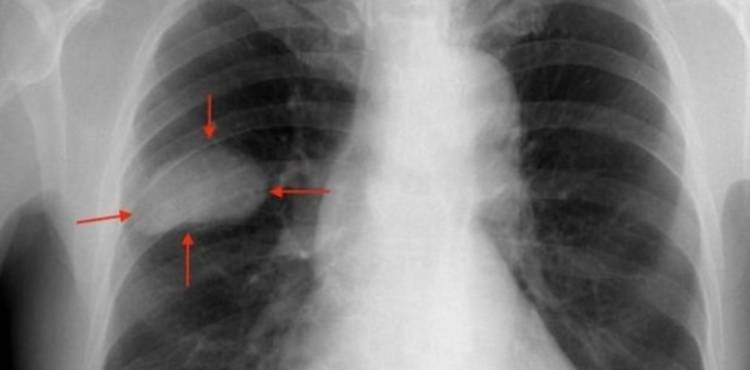 Cáncer de pulmón: llegó al país un tratamiento que logra una sobrevida inédita